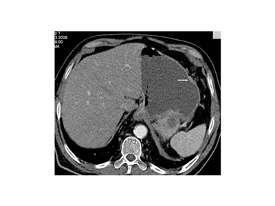 Sürrenal Tomografi