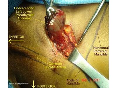 Paratiroid Adenomu İçin Minimal Invaziv Cerrahi