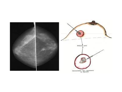 Tel İle İşaretlenmiş Meme Biopsisi